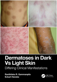 Dermatoses in Dark Vs Light Skin: Differing Clinical Manifestations