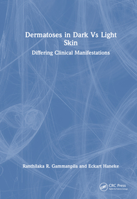 Dermatoses in Dark Vs Light Skin: Differing Clinical Manifestations